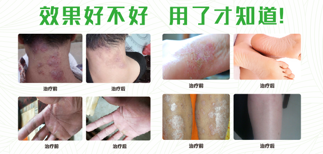 草莓视频苹果下载真菌清喷剂